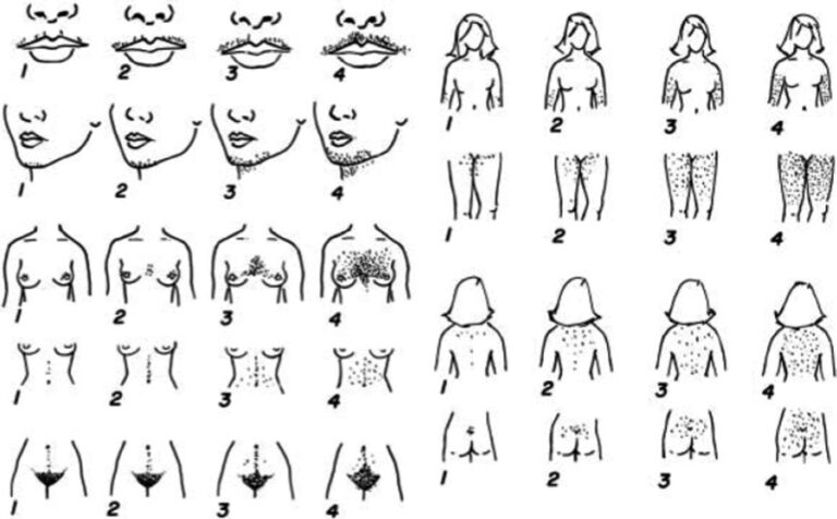 Фото: Гирсутизм